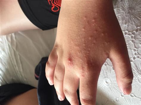Anyone Know If This Rash Is Lupus Or Not Lupus Uk