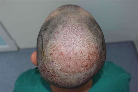 Balding Crown The Early Signs Hair Transplant Turkey