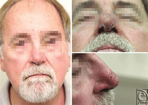 Nasal Tip 8 Weeks After Full Thickness Skin Grafting Download