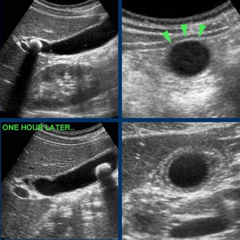 Gallbladder Ultrasound Stones