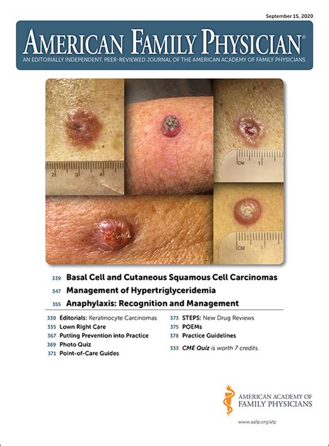 Basal Cell And Cutaneous Squamous Cell Carcinomas Diagnosis And Treatment AAFP