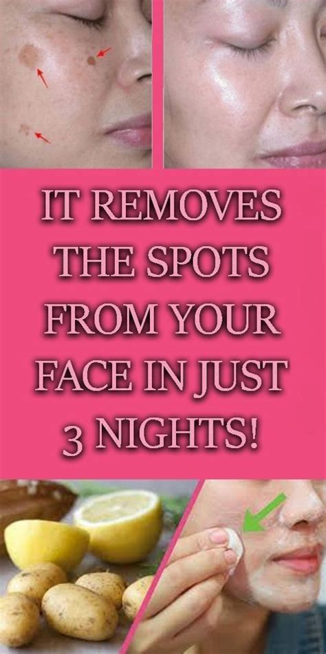 it removes the spots from your face in just 3 nights health and beauty queen