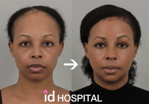 Forehead Reduction Surgery Scalp Advancement Idhospital