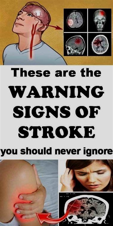 Knowing These 12 Symptoms Of A Stroke Can Be Life Saving Stroke Symptoms Health Healthy