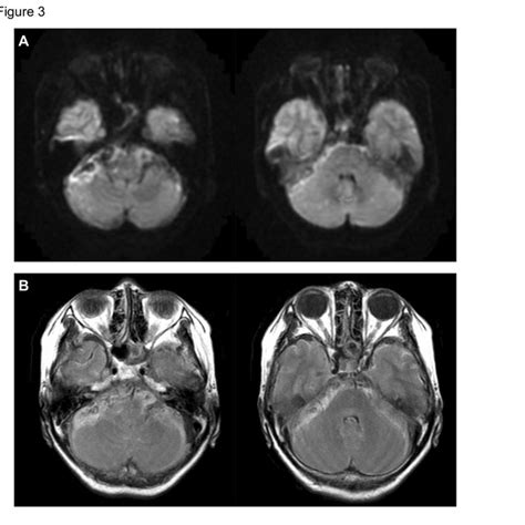 A Magnetic Resonance Diffusion Weighted Imaging Shows No Apparent