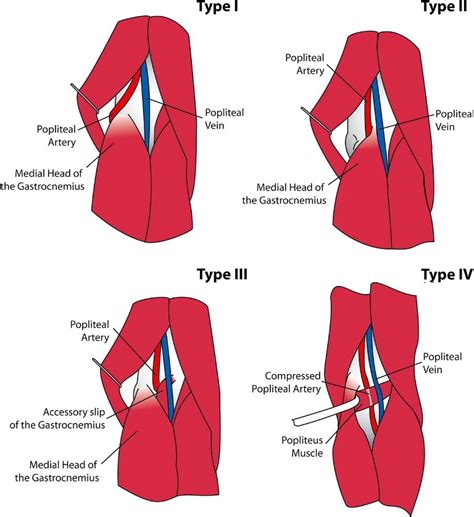 Popliteal Artery Entrapment Syndrome Bone And Spine