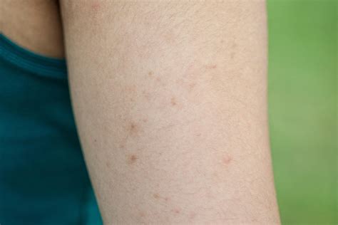 Keratosis Pilaris How To Get Rid Of Chicken Skin Readers Digest