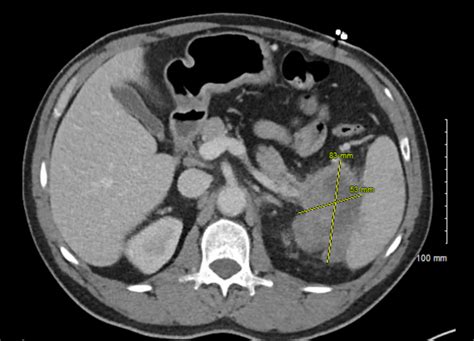 Cureus Primary Pancreatic Lymphoma An Uncommon Presentation In The