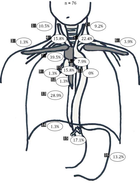 Pattern Of Lymph Node Metastases 1 Right Cervical 2 Left Cervical