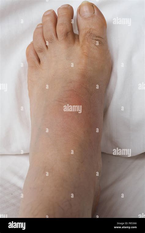 A Swollen Left Foot With Gout Stock Photo Alamy