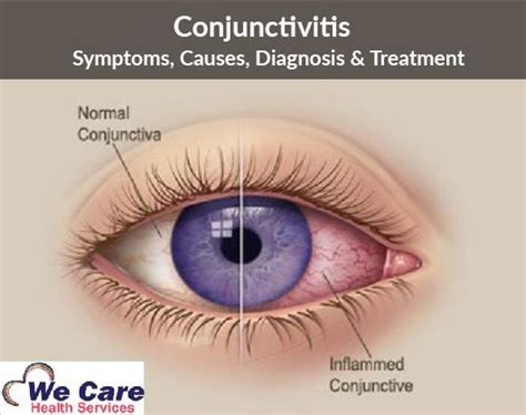 What Is Pink Eye Conjunctivitis Symptoms And Causes What Is Pink