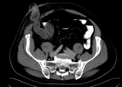 Ct Of The Abdomen Axial Image With Intravenous And Oral Contrast