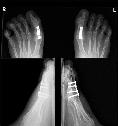 Arthrodesis Of The First Metatarsophalangeal Joint For Severe Hallux