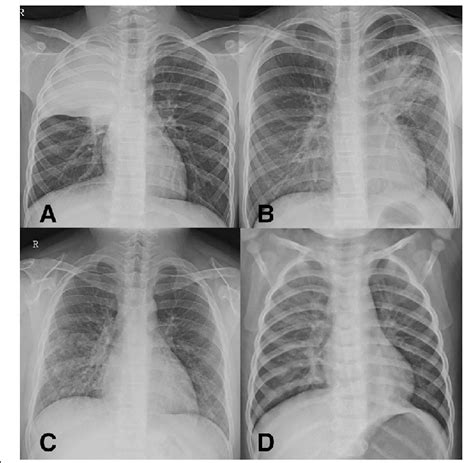 Four Categories Of Chest X Rays Of Mycoplasma Pneumoniae My Xxx Hot Girl
