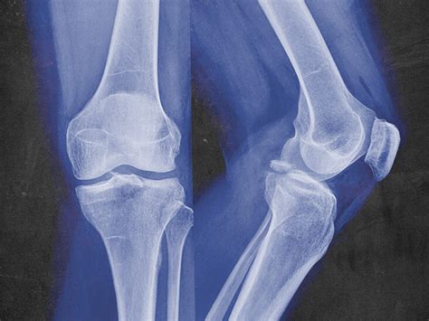 Bone Fracture Facts You Need To Know Health Blogster