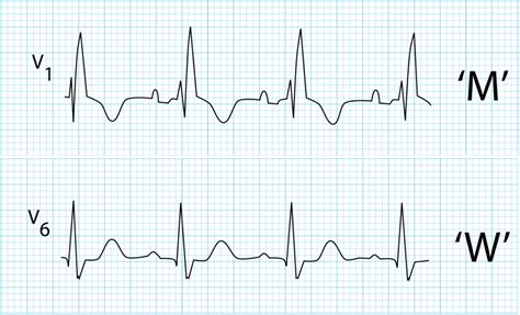 Right Bundle Branch Block Rbbb • Litfl • Ecg Library Diagnosis