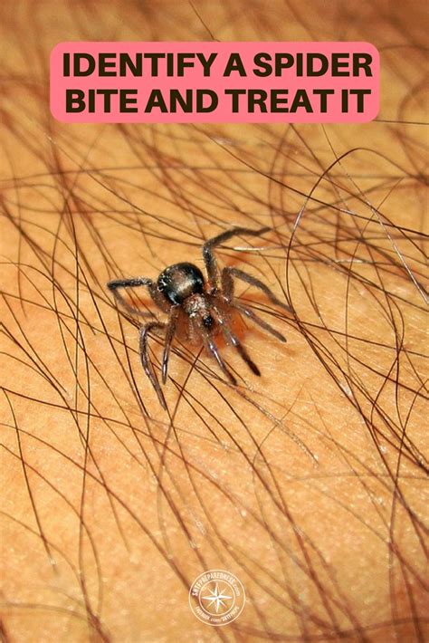 How To Identify A Spider Bite And Treat It
