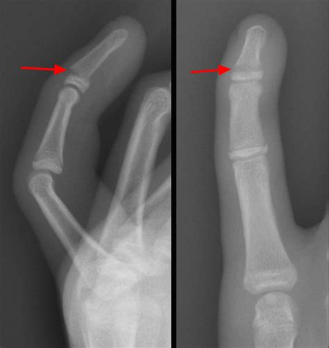 Growth Plate Fracture Causes Types Symptomstreatment