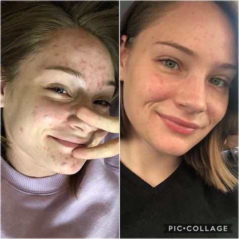 Pre Accutane — One Month Left My Favorite Part About Clear Skin Is