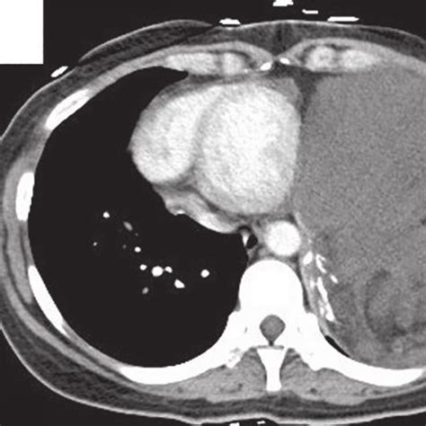 Triple Phase Abdominal CT Showing 7 Cm Low Density Lesion In Right Lobe