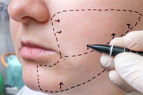 What Is Cheek Augmentation Surgery Cosmetic Surgery Ca