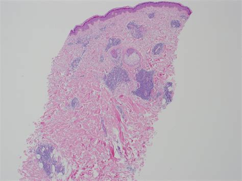 Figure 4x Histopathology Of Tumid Lupus Erythematosus Statpearls