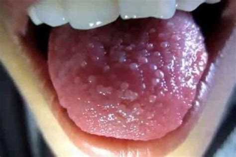 White Spots On Tongue Tip Side Under Back Dots