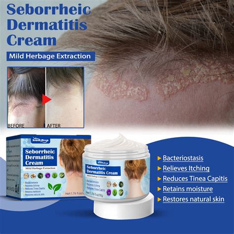Seborrheic Dermatitis Cream Psoriasis Scalp Treatment Folliculitis