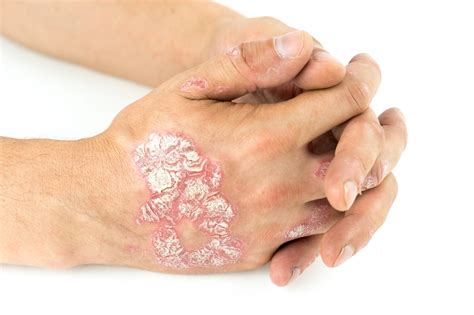 New Treatment For Psoriasis Ajp