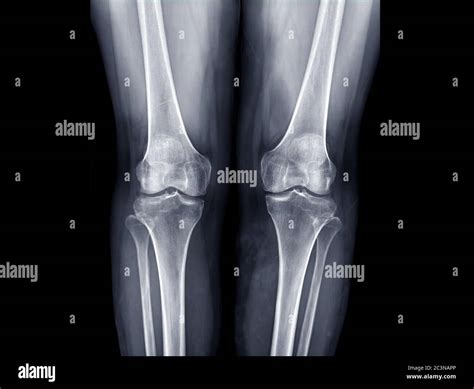 X Ray Image Of Both Knee Ap View For Detect Osteoarthritis Knee Or Oa
