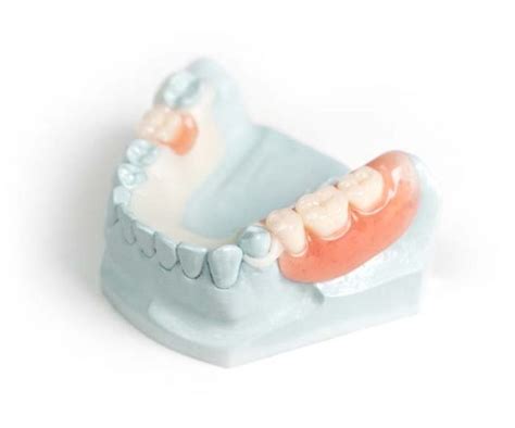 Zirlux Acetal Resin Partial Dentures Stomadent Dental Lab