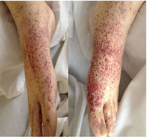 Right And Left Foot And Ankle Showing Petechial And Purpuric Skin Rash