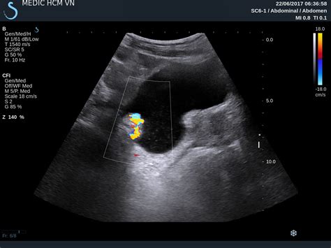 Vietnamese Medic Ultrasound Case 439 Urinary Bladder Tumor Dr Phan