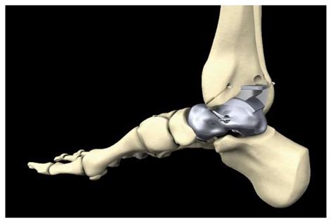 Development Of An Internally Braced Prosthesis For Total Talus Replacement
