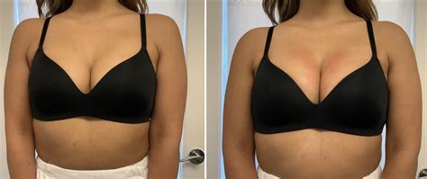 Large Breast Lift Before And After