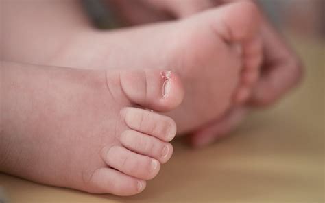 How To Prevent And Treat Your Babys Ingrown Toenails Mvs Podiatry