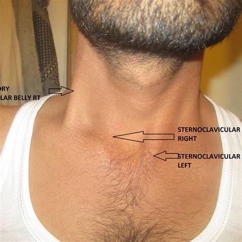 A Right Accessory Clavicular Sternocleidomastoid Inserting At