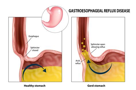 Diagnosis And Management Of Typical And Atypical Gastroesophageal
