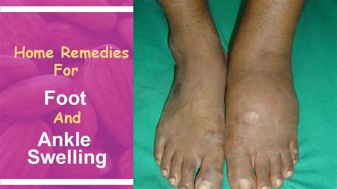 Home Remedies For Foot And Ankle Swelling Youtube