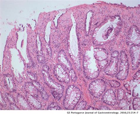 Mucosal Prolapse Polyp Mimicking Rectal Malignancy A Case Report Ge