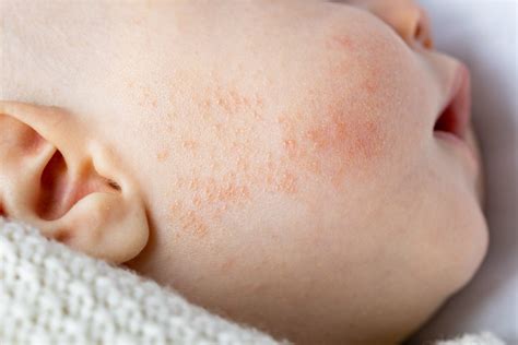 8 Common Skin Problems In Babies And Their Solutions Being The Parent