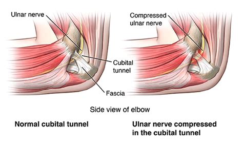 Ulnar Nerve Entrapment Physiophi Physical Therapy