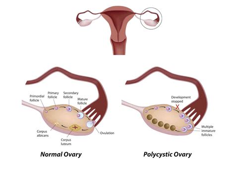 What Is Polycystic Ovarian Syndrome