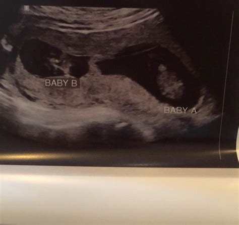 10 Weeks Ultrasound Surprise Second Generation Twins Rdaddit