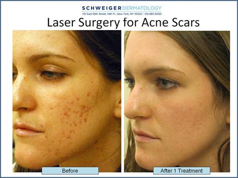 Plastic Surgery Acne Scars Before And After