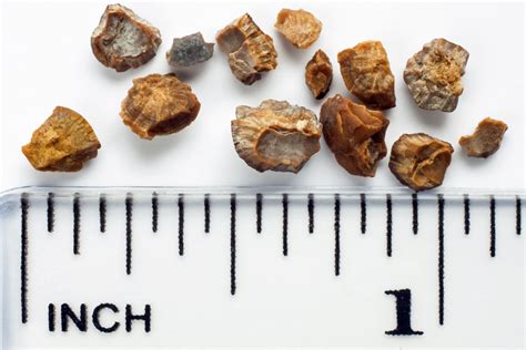 The Four Types Of Kidney Stones And How To Limit Them Ksptabs