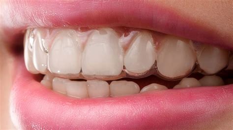How can you correct crooked teeth without wearing metal braces? Straighten Your Teeth Without Braces