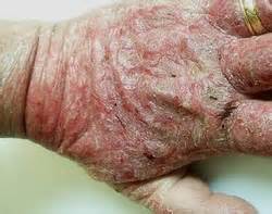Dermatite Da Contatto Sottotipi Cause Sintomi Diagnosi E Cura The