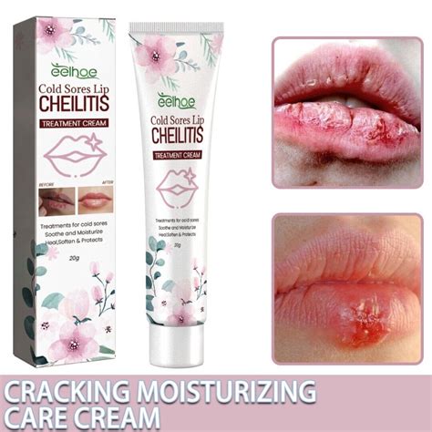Cold Sores Lip Cheilitis Treatment Cream For Dry Chapped Peeling