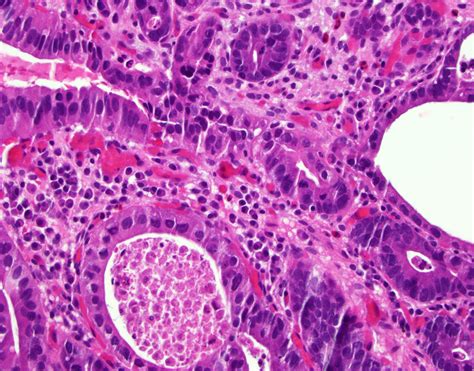 Pathology Outlines Barrett Related Dysplasia